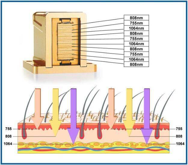 Velvet Ice Diode Laser Hair Removal Newcastle Laser Clinic